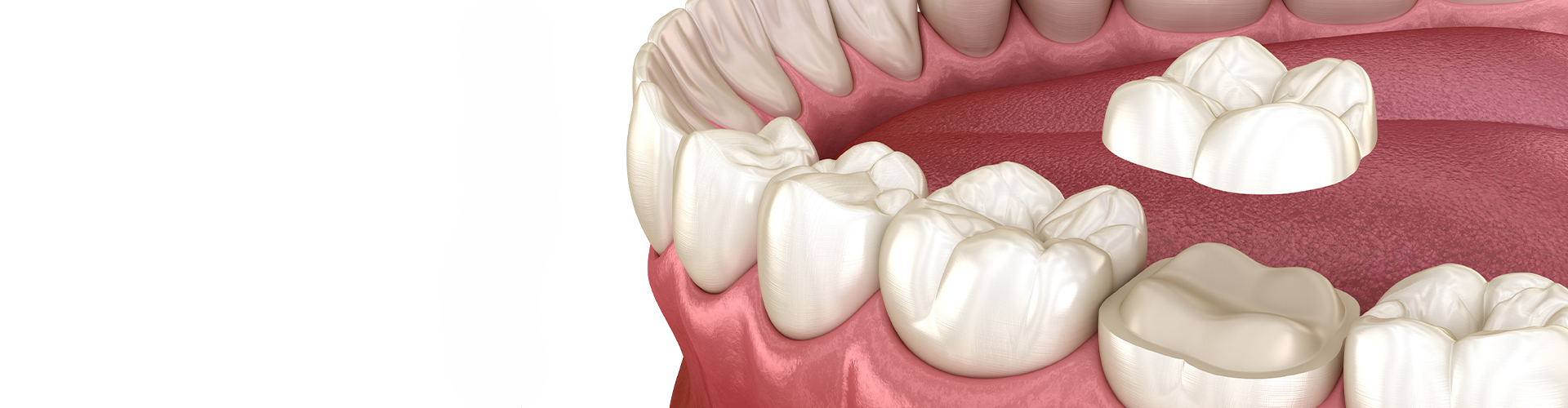 rendering of an onlay being placed on a molar